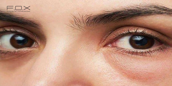 Kem che khuyết điểm mắt có công dụng thế nào?